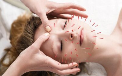 Mengenal Akupuntur Peremajaan Wajah atau Kosmetika